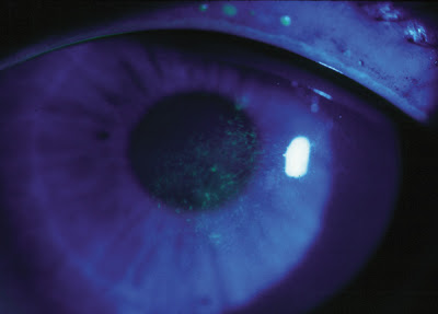 Reclaiming Vision In Dry-Eye Syndrome